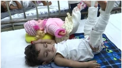 ചികിത്സയ്ക്കായി 'അവസാനത്തെ അടവ്'; കുഞ്ഞിനൊപ്പം പാവയ്ക്കും പ്ലാസ്റ്ററിട്ട് ഡോക്ടര്മാര്!