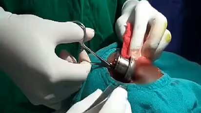 जब आंख में जा घुसी प्रेशर कुकर की सीटी, करना पड़ा ऑपरेशन, आप भी ऐसे बरतें सावधानी