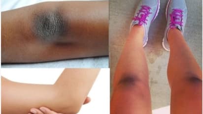 ಮೊಣಕೈ ಮತ್ತು ಮೊಣಕಾಲಿನ ಟ್ಯಾನಿಂಗ್‌ಗೆ ಇಲ್ಲಿದೆ ಮನೆಮದ್ದು...