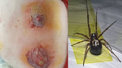 ചിലന്തിയുടെ കടിയേറ്റ യുവാവിന് സംഭവിച്ചത്; ഞെട്ടിക്കും ഈ ചിത്രങ്ങള്