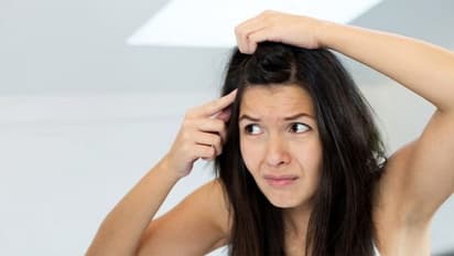 താരൻ അകറ്റാൻ ഇതാ 5 എളുപ്പ വഴികൾ