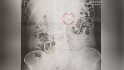 വിവാഹമോതിരം വിഴുങ്ങുന്നതായി സ്വപ്നം കണ്ടു; ഉണര്ന്നപ്പോള് കണ്ടത്...