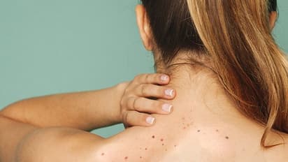 ശരീരത്തില് കാണുന്ന കറുത്ത പാടുകള് അലട്ടുന്നുവോ? വീട്ടില് ചെയ്യാം ഇക്കാര്യങ്ങള്...