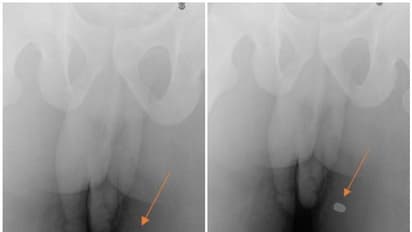 അബദ്ധത്തില് കാഞ്ചി വലിച്ചു; യുവാവിന്റെ ലിംഗം തുളച്ച് വെടിയുണ്ട