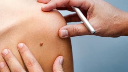 സ്കിന്‍ ക്യാന്‍സറിന്‍റെ ശ്രദ്ധിക്കാതെ പോകുന്ന ചില ലക്ഷണങ്ങള്‍...