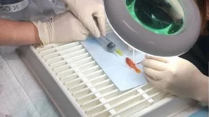 1 ಗ್ರಾಂ ಮೀನು, 40 ನಿಮಿಷ ಆಪರೇಶನ್, 8 ಸಾವಿರ ಖರ್ಚು: ಜಗತ್ತಿನ ಅತೀ ಚಿಕ್ಕ ರೋಗಿ!