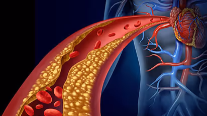 ഈ അഞ്ച് കാര്യങ്ങൾ ശ്രദ്ധിച്ചാൽ കൊളസ്ട്രോൾ കുറയ്ക്കാം