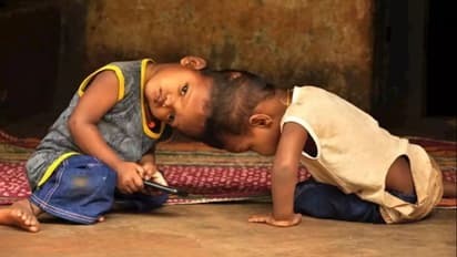 2 साल पहले अलग हुए थे जुड़वा भाइयों के सिर, एक वेंटिलेटर पर तो दूसरे का है ये हाल
