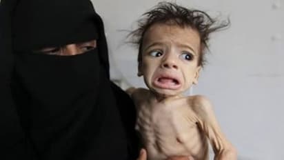 പട്ടിണി മൂലം ഓരോ മണിക്കൂറിലും ആറ് കുഞ്ഞുങ്ങള് വീതം മരിച്ചുവീഴുന്ന നാട്