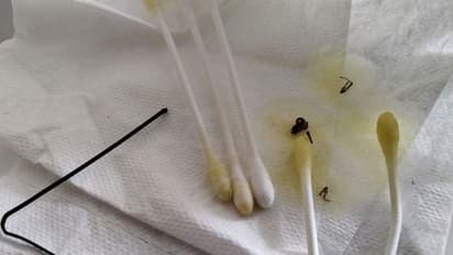 ചെവിയില് നിന്ന് ശബ്ദവും ചൊറിച്ചിലും; ബഡ്സ് ഇട്ടുനോക്കിയപ്പോള് കിട്ടിയത്...