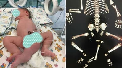 മൂന്ന് കാലുകള്‍, രണ്ട് ലിംഗം, മലദ്വാരമില്ല; ജീവിതത്തോട് പോരാടി ഒരു കുഞ്ഞ്