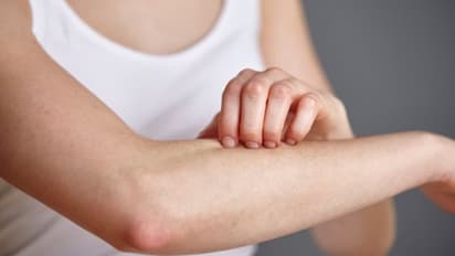 Rashes to dark skin: 6 skin conditions that can be warning signs of diabetes