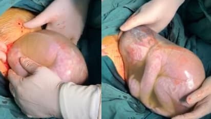 അപൂര്വ്വങ്ങളില് അപൂര്വ്വം; അമ്മയേയും കുഞ്ഞിനേയും രക്ഷിക്കാന് അസാധാരണ മാര്ഗം സ്വീകരിച്ച് ഡോക്ടര്മാര്