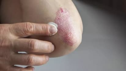 തൊലിപ്പുറത്ത് കാണുന്ന ഈ രോഗം വേനലില് എങ്ങനെ നിയന്ത്രിക്കാം?