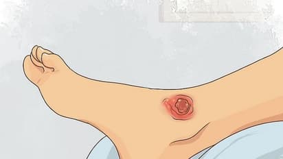 ಸಿಕಲ್ ಸೆಲ್ ಅನಿಮಿಯಾ ಅಂದ್ರೇನು?ಅಷ್ಟು ಗಂಭೀರ ಸಮಸ್ಯೆಯೇ?