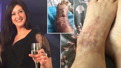 ആദ്യം കണ്ടത് വട്ടത്തിൽ ചുവന്നു തടിച്ച പാട്, രാത്രിയായപ്പോൾ ഇടത് കാൽ വീർത്തു പൊങ്ങി, ഡോക്ടറെ കണ്ടപ്പോൾ...