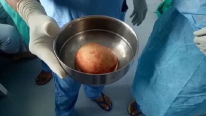 ಮೂತ್ರಪಿಂಡದಿಂದ ದಾಖಲೆ ಗಾತ್ರದ ಕಲ್ಲು ಹೊರತೆಗೆದ ವೈದ್ಯರು