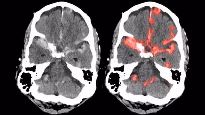 ಸೆಕೆಂಡ್‌ನಲ್ಲಿ ಬ್ರೈನ್ ಹ್ಯಾಮ್ರೇಜ್ ಗುರುತಿಸುವ ಯಂತ್ರ: ಭಾರತೀಯ ಮೂಲದ ವೈದ್ಯರ ಸಾಧನೆ!