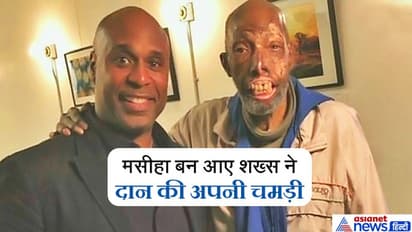 एक्सीडेंट में बुरी तरह बिगड़ गया था चेहरा, ना बचे थे होंठ ना नाक