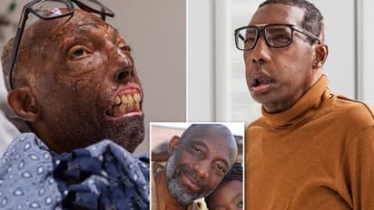 ഇടത് ചെവിയും മൂക്കിന്റെ ഭൂരിഭാഗവും നഷ്ടപ്പെട്ടു, ശരീരം പകുതിയോളം പൊള്ളലേറ്റു; മുഖം മാറ്റിവയ്ക്കൽ ശസ്ത്രക്രിയ വിജയകരം