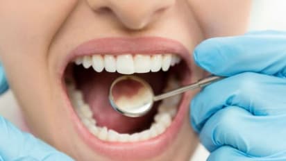 പല്ലിന്‍റെ ആരോഗ്യം സംരക്ഷിക്കുന്നതിലൂടെ നാം തടയുന്ന രോഗങ്ങള്‍...