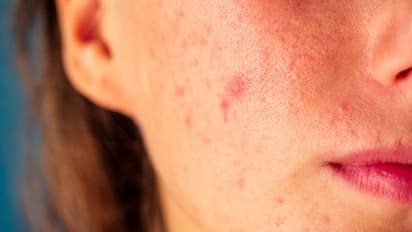 ശരീരത്തിൽ സ്ഥിരമായി കുരുക്കൾ ഉണ്ടാകാറുണ്ടോ; കാരണങ്ങൾ അറിയാം