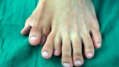 കാലില് ഒമ്പത് വിരലുകളുമായി ഒരു യുവാവ്; ഒടുവില് ശസ്ത്രക്രിയ...