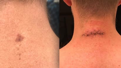 കഴുത്തിന്റെ പിന്ഭാഗത്ത് ഉണ്ടായിരുന്ന ചെറിയ മറുകിനെ നിസാരമായി കണ്ടു; കുറെ നാൾ കഴിഞ്ഞപ്പോൾ സ്കിൻ ക്യാൻസറാണെന്ന് തിരിച്ചറിഞ്ഞു