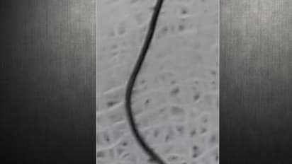 തിരുവനന്തപുരം മെഡിക്കല്‍ കോളേജില്‍ അതി സങ്കീര്‍ണ ശത്രക്രിയ; അന്നനാളത്തിനിടയില്‍ കുടുങ്ങിയ കമ്പികക്ഷണം പുറത്തെടുത്തു