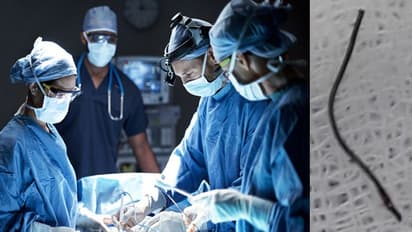 സി ടി സ്കാനിലും എന്ഡോസ്കോപിയിലും കണ്ടെത്തിയില്ല; യുവാവിന്റെ തൊണ്ടയില് കുടുങ്ങിയ കമ്പി കഷ്ണം പുറത്തെടുത്തത് ഇങ്ങനെ