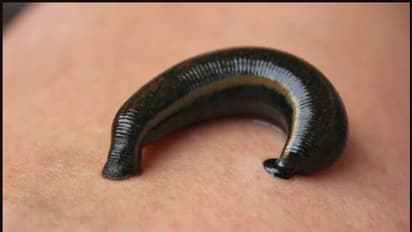 യുവാവിന്റെ ജനനേന്ദ്രിയത്തിൽ നിന്നും നീക്കം ചെയ്തത് 7 സെന്റിമീറ്റര് നീളമുള്ള അട്ട