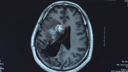 തലയില് തരിപ്പും ബോധക്കേടും; തലച്ചോറ് പരിശോധിച്ച ഡോക്ടര്മാര് കണ്ടത് !