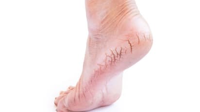 Here's how you can say goodbye to cracked heels with these home remedies