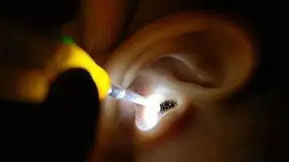 காதில் குட்டி போட்டு குடித்தனம் செய்த கரப்பான் பூச்சி ..! வாலிபரின் வலது காதில்...திக் திக்  காட்சி..!