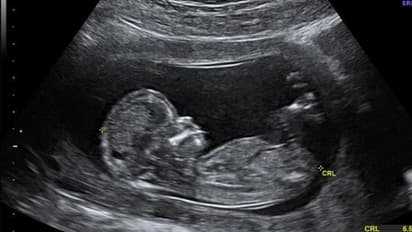 ಮೊದಲ ಬಾರಿ ಹೊಕ್ಕುಳ ಬಳ್ಳಿಯಲ್ಲೂ ಪ್ಲಾಸ್ಟಿಕ್ ಪತ್ತೆ!