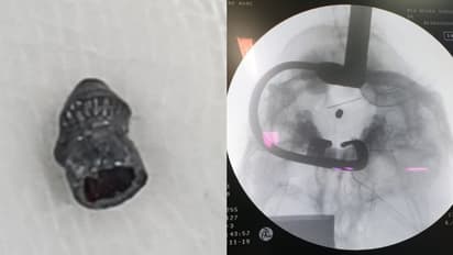 തലയോട്ടിയില് തറച്ചുനിന്ന വെടിയുണ്ട പുറത്തെടുത്തു; തിരുവനന്തപുരം മെഡിക്കല് കോളേജില് വീണ്ടും അവിശ്വസനീയ ശസ്ത്രക്രിയ