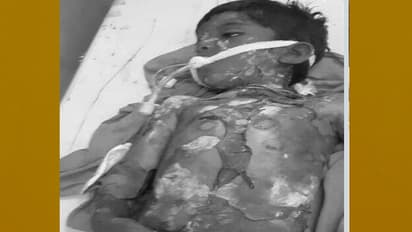 విషాదం...ఆరేళ్ల బాలుడిని బలితీసుకున్న వేడి సాంబారు