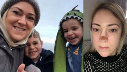 മൂക്കിന്റെ തുമ്പത്ത് വന്ന മറുക് പിന്നീട് ദ്വാരമായി മാറി; വീട്ടമ്മയ്ക്ക് സംഭവിച്ചത്...