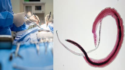 ലിംഗത്തിനുള്ളില് മുട്ടയിട്ട് വിര; യുവാവ് മരണത്തില് നിന്ന് രക്ഷപ്പെട്ടത് കഷ്ടിച്ചത്