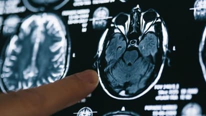 സ്കാൻ റിപ്പോര്ട്ട് അവഗണിച്ചു; ബ്രെയിന് ട്യൂമര് ബാധിച്ച് മരിച്ച 25 വയസുകാരന് ചികിത്സ ലഭിച്ചില്ലെന്ന് കുടുംബം