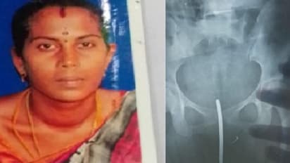 பெண்ணின் வயிற்றுக்குள் ஊசியை வைத்து தைத்த செவிலியர்கள்..! பிரசவத்தின் போது நிகழ்ந்த கொடூரம்..!