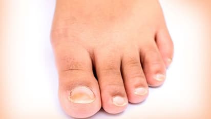 নখকুনির সমস্যায় ভুগছেন, ঘরোয়া টোটকায় মিলবে মুক্তি