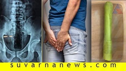 ಗುದದ್ವಾರ ಹೊಕ್ಕಿದ್ದ ಪೊರಕೆ ಪ್ಲಾಸ್ಟಿಕ್ ಹಿಡಿ ಹೊರ ತೆಗೆದ ವೈದ್ಯರು!