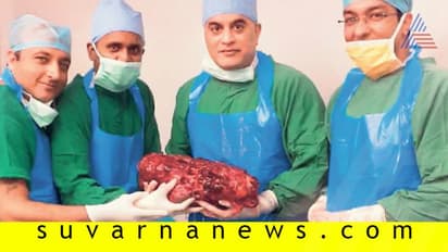 7.4 ಕೆ.ಜಿ. ತೂಕದ ಕಿಡ್ನಿ ಹೊರತೆಗೆದ ವೈದ್ಯರು!