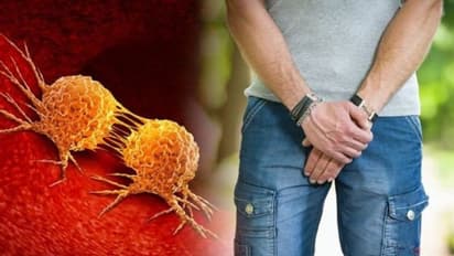 മൂത്രത്തിന്‍റെ ഗന്ധത്തില്‍ നിന്ന് പ്രോസ്റ്റ്രേറ്റ് കാന്‍സര്‍ കണ്ടെത്താം; ഇ - നോസുമായി ഗവേഷകര്‍