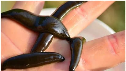 രണ്ട് മാസം തുടര്ച്ചയായ ചുമ; പരിശോധനയിൽ തൊണ്ടയിൽ കണ്ടെത്തിയത് കുളയട്ട