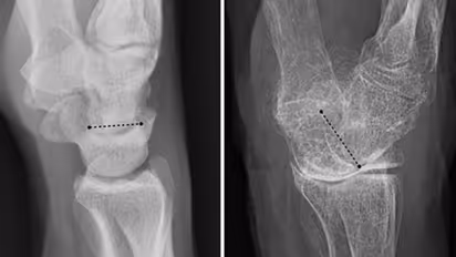 എന്താണ് 'ഓസ്റ്റിയോ പൊറോസിസ്'; എങ്ങനെ തടയാം