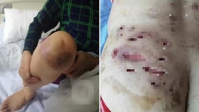 बिना साफ किए 1 ही इंजेक्शन से इलाज कर रहा था डॉक्टर, सड़ गई 115 लोगों की चमड़ी