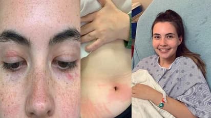 മാസത്തില്‍  രണ്ടുതവണ കുളി, സ്വന്തം തുപ്പലും കണ്ണുനീരും വരെ അലർജി; അപൂർവ രോഗവുമായി ഇരുപത്തൊന്നുകാരി