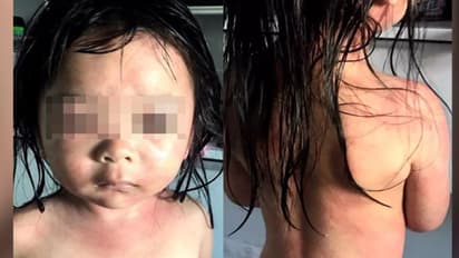 सस्ते क्लोरीन पाउडर से करते थे स्विमिंग पूल की सफाई, पानी में ऐसे जल गई बच्ची की चमड़ी